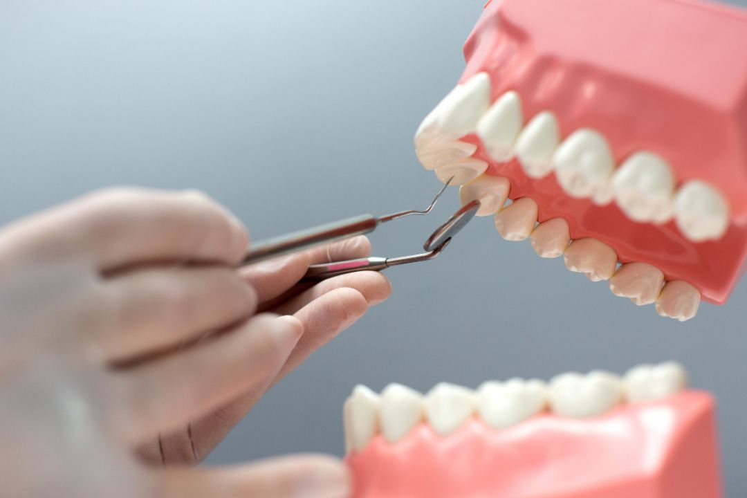 Dental model showing preparation steps for full mouth dental implants procedure by a dentist